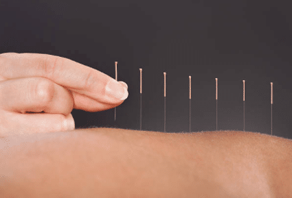 dry needling