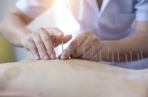 Dry Needling in Adelaide: What is it and how can it help me?