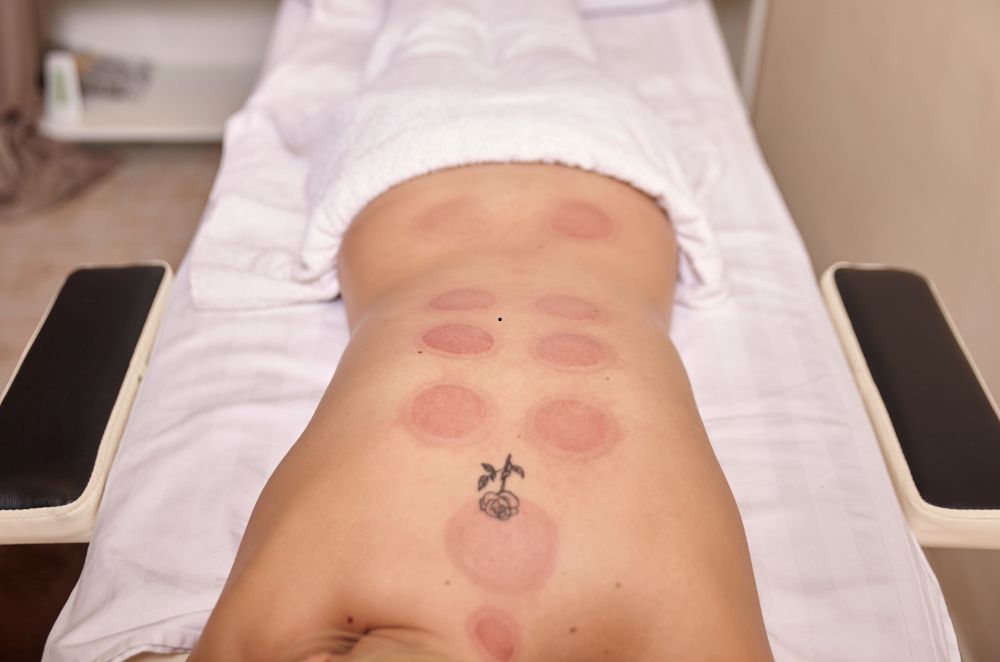 cupping therapy4