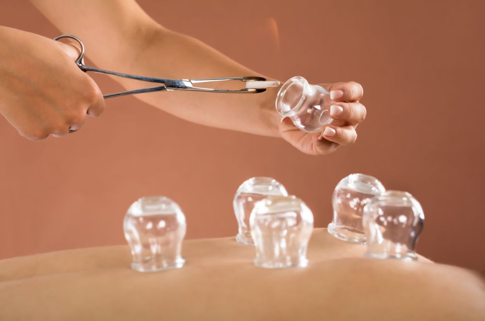 Cupping Therapy in Adelaide