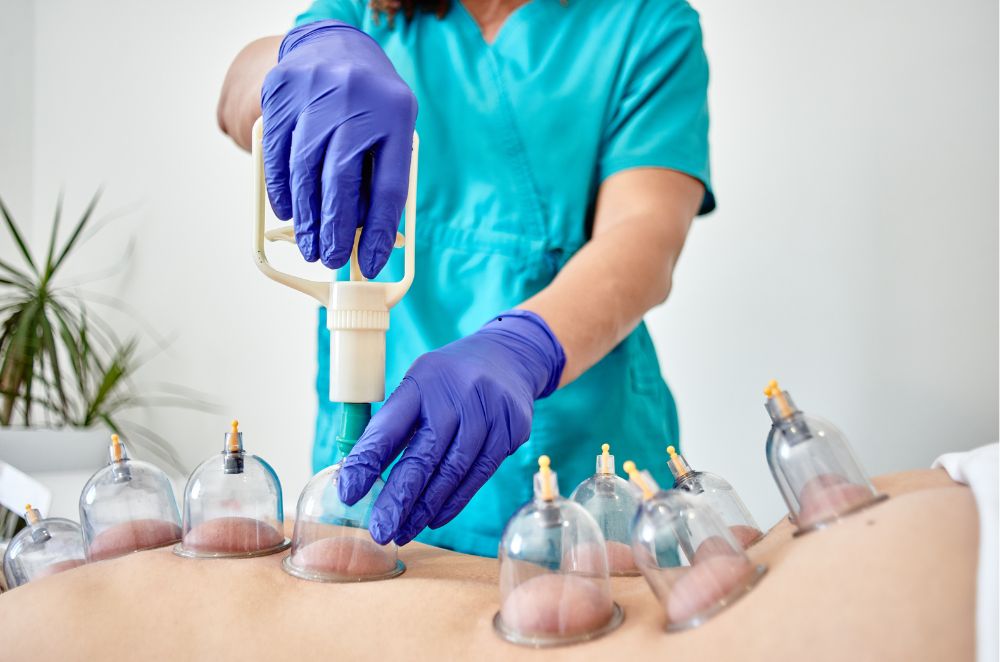 Cupping Therapy in Adelaide