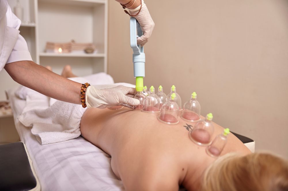 Cupping Therapy in Adelaide