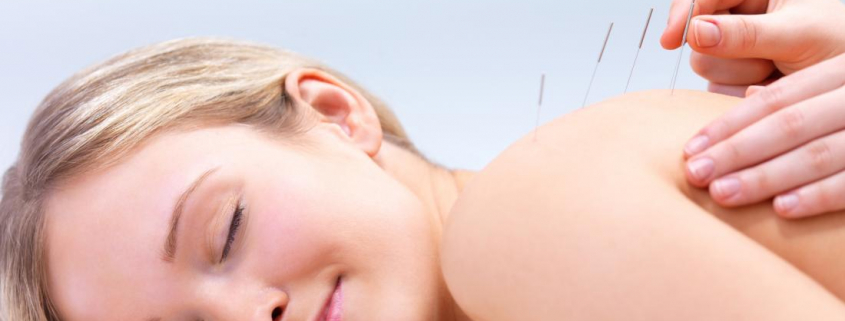 Dry Needling and Acupuncture for Stress and Anxiety