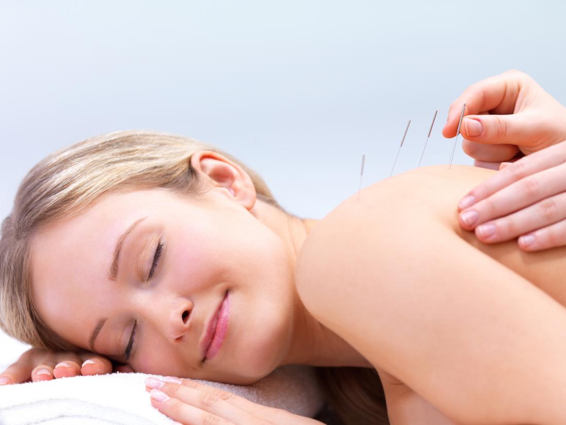 Dry Needling and Acupuncture for Stress and Anxiety