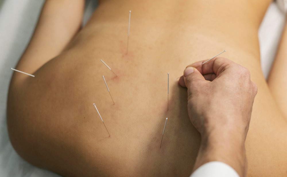 Acupuncture Helps Treat Frozen Shoulder