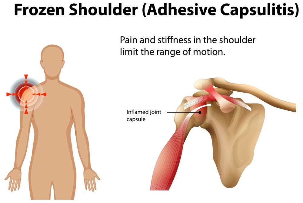 Frozen shoulder adhesive capsulitis