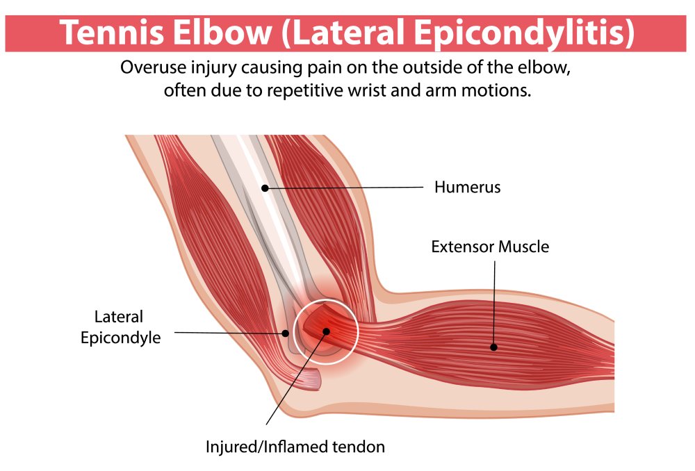 Tennis elbow lateral epicondylitis