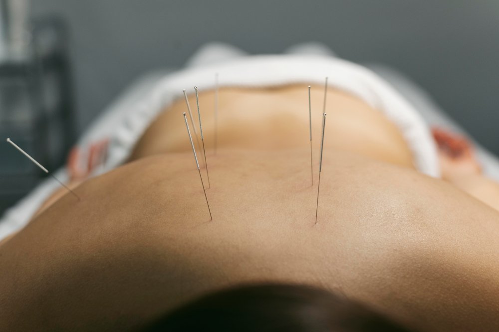 acupuncture help for tennis elbows