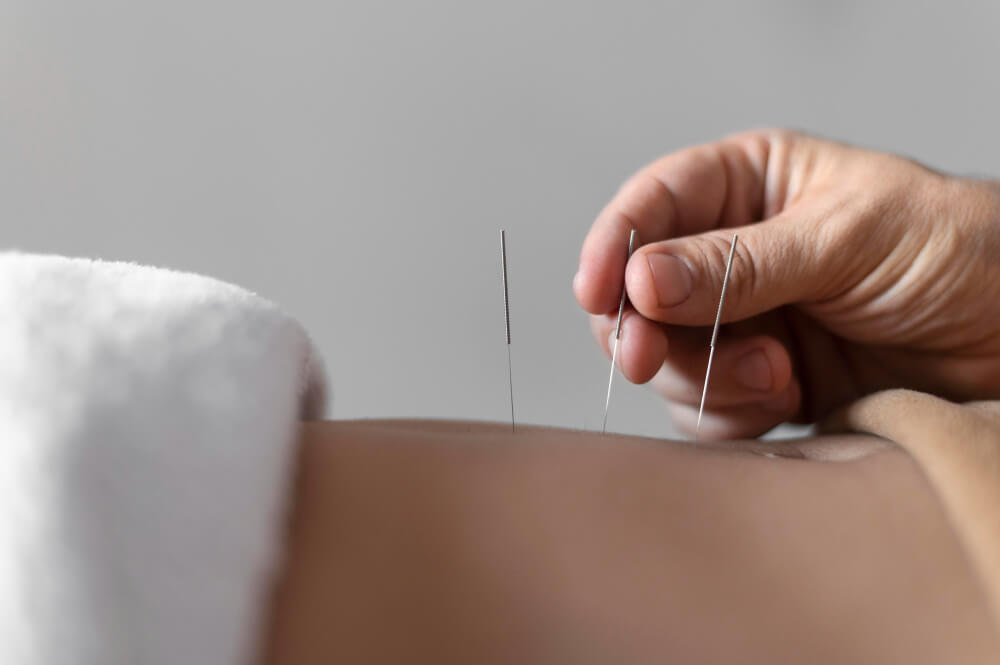 acupuncture control weight