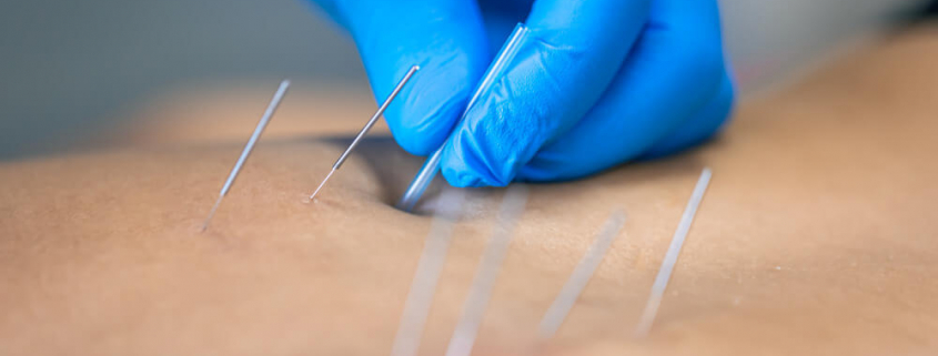 acupuncture nerve pain