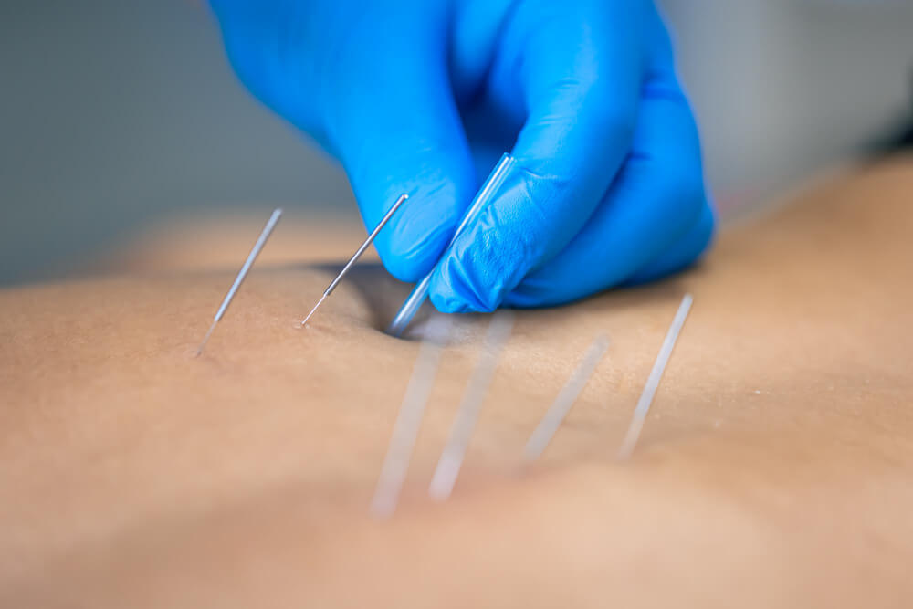 acupuncture nerve pain