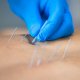 acupuncture nerve pain
