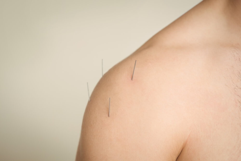 Acupuncture Costing