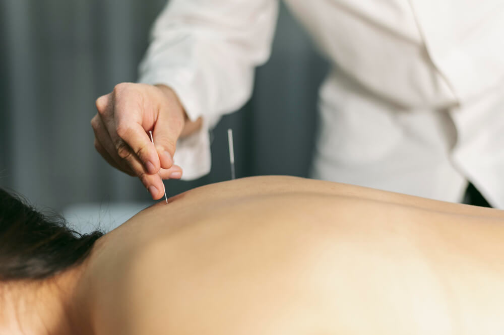 Acupuncture Costs Adelaide