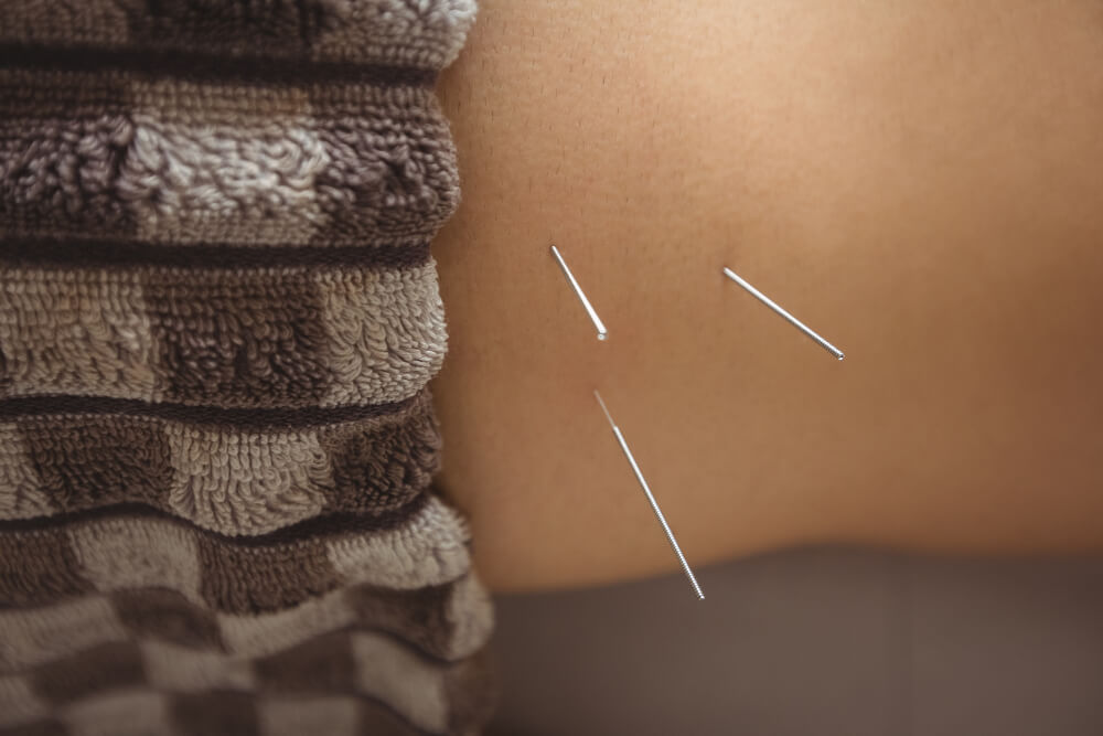 acupuncture