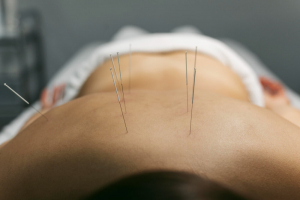 Dry Needling vs. Acupuncture: Understanding the Key Differences