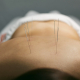 dry needling vs acupuncture