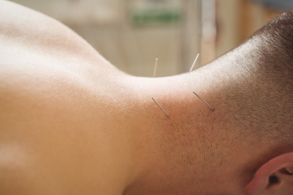 dry needling