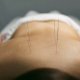 dry needling vs acupuncture