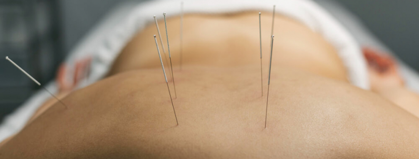 dry needling vs acupuncture