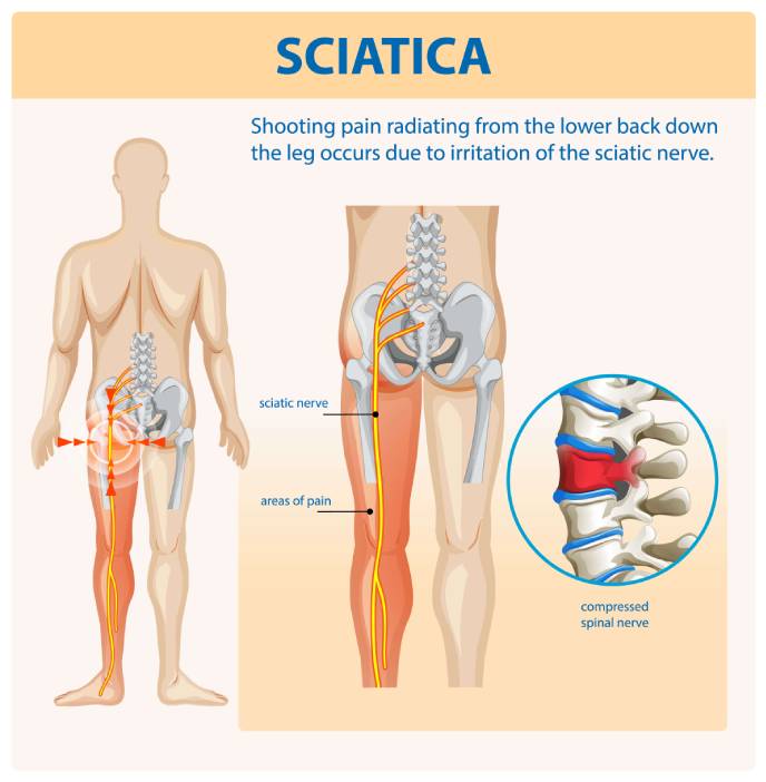 Sciatica